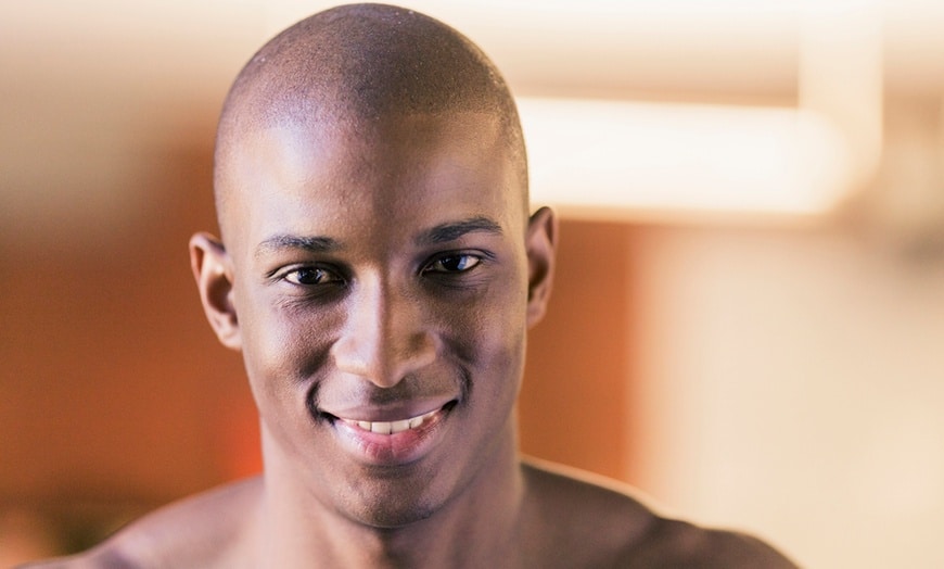 scalp micropigmentation on spanish male with dark skin