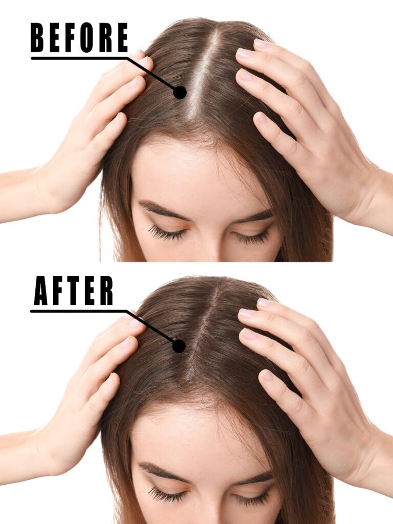 Scalp Micropigmentation For Women SCALPS Scalp Micropigmentation